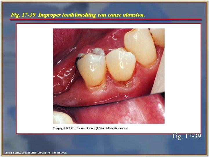 Fig. 17 -39 Improper toothbrushing can cause abrasion. Fig. 17 -39 Copyright 2003, Elsevier