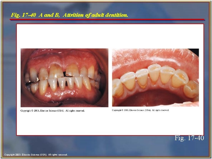 Fig. 17 -40 A and B, Attrition of adult dentition. Fig. 17 -40 Copyright