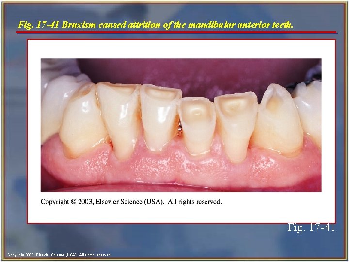 Fig. 17 -41 Bruxism caused attrition of the mandibular anterior teeth. Fig. 17 -41