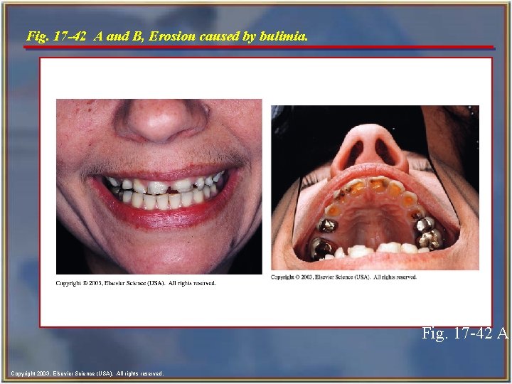 Fig. 17 -42 A and B, Erosion caused by bulimia. Fig. 17 -42 A