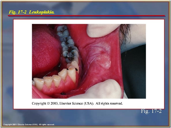 Fig. 17 -2 Leukoplakia. Fig. 17 -2 Copyright 2003, Elsevier Science (USA). All rights