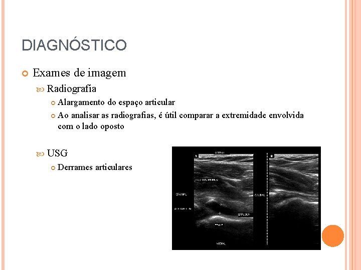 DIAGNÓSTICO Exames de imagem Radiografia Alargamento do espaço articular Ao analisar as radiografias, é