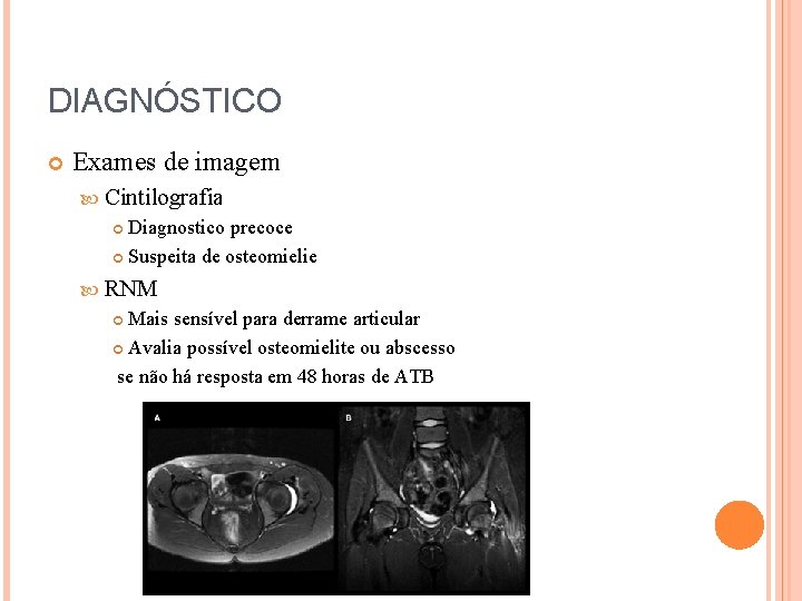 DIAGNÓSTICO Exames de imagem Cintilografia Diagnostico precoce Suspeita de osteomielie RNM Mais sensível para
