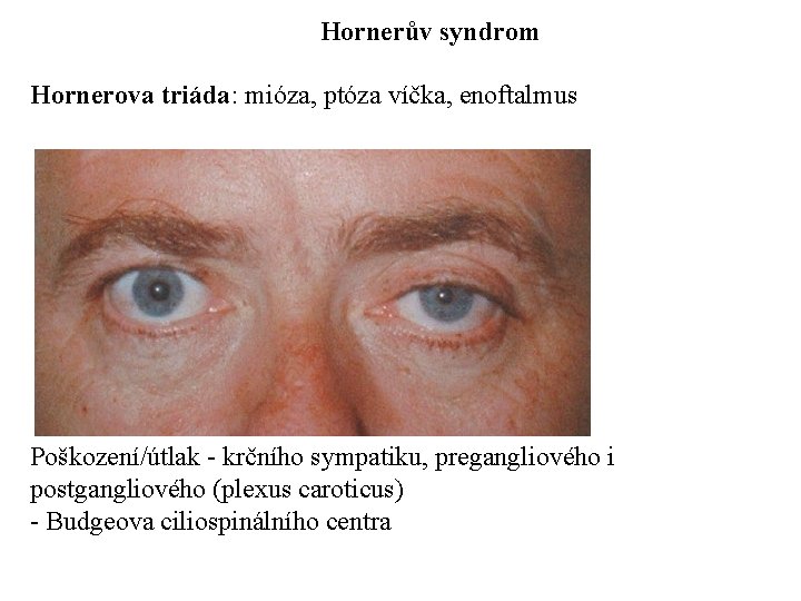 Hornerův syndrom Hornerova triáda: mióza, ptóza víčka, enoftalmus Poškození/útlak - krčního sympatiku, pregangliového i
