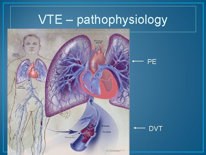 VTE – pathophysiology PE DVT 