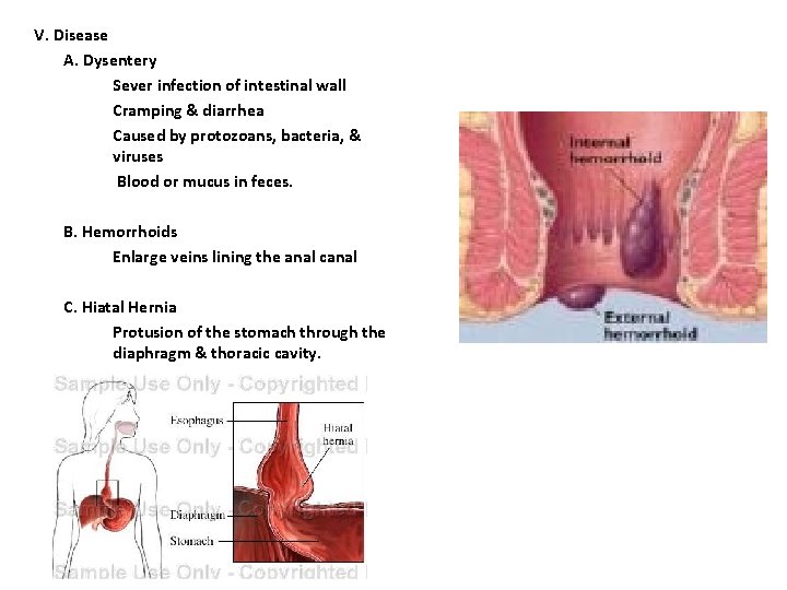 V. Disease A. Dysentery Sever infection of intestinal wall Cramping & diarrhea Caused by V. Disease A. Dysentery Sever infection of intestinal wall Cramping & diarrhea Caused by