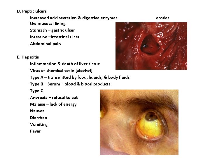 D. Peptic ulcers Increased acid secretion & digestive enzymes the mucosal lining. Stomach – D. Peptic ulcers Increased acid secretion & digestive enzymes the mucosal lining. Stomach –