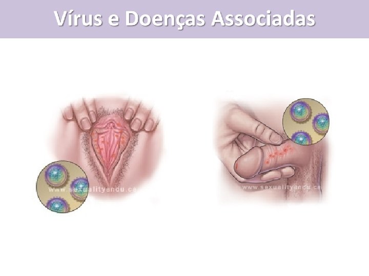 Vírus e Doenças Associadas 