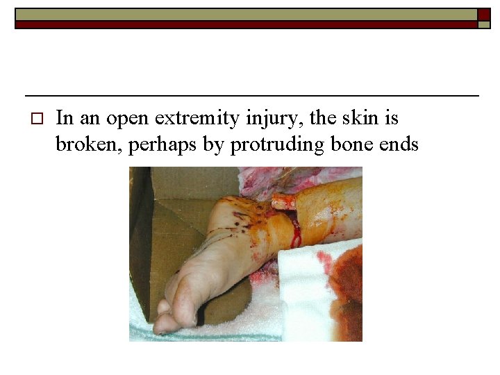 o In an open extremity injury, the skin is broken, perhaps by protruding bone