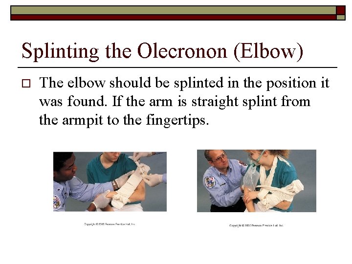 Splinting the Olecronon (Elbow) o The elbow should be splinted in the position it