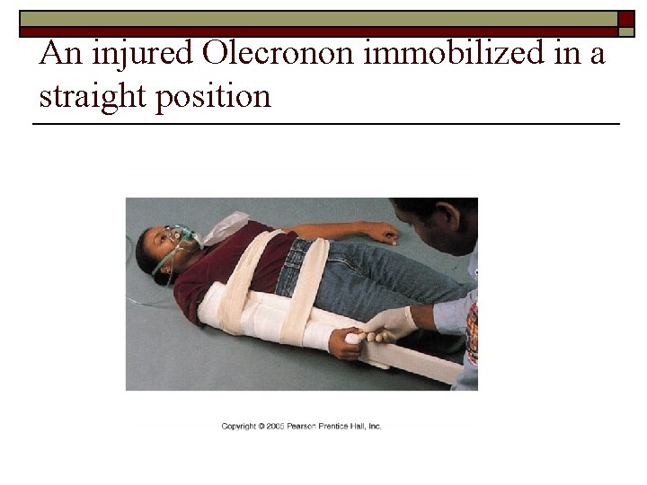 An injured Olecronon immobilized in a straight position 