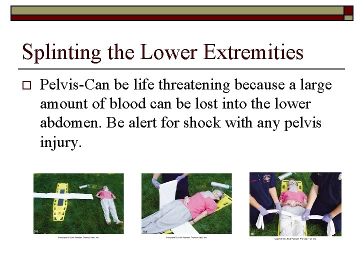 Splinting the Lower Extremities o Pelvis-Can be life threatening because a large amount of