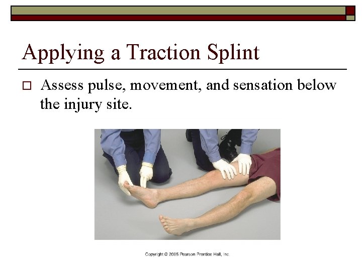 Applying a Traction Splint o Assess pulse, movement, and sensation below the injury site.