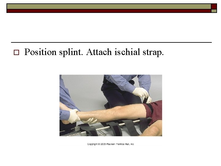 o Position splint. Attach ischial strap. 