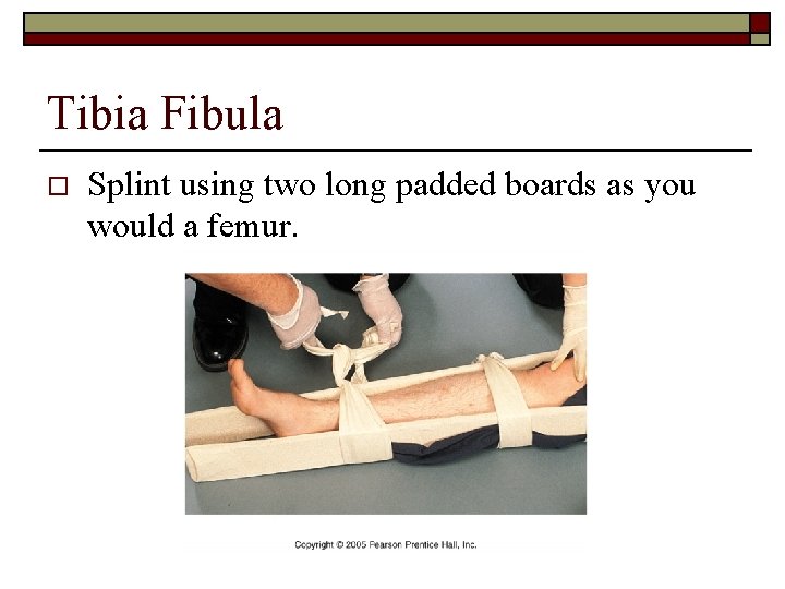 Tibia Fibula o Splint using two long padded boards as you would a femur.