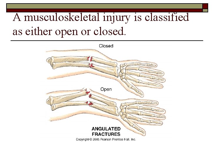 A musculoskeletal injury is classified as either open or closed. 