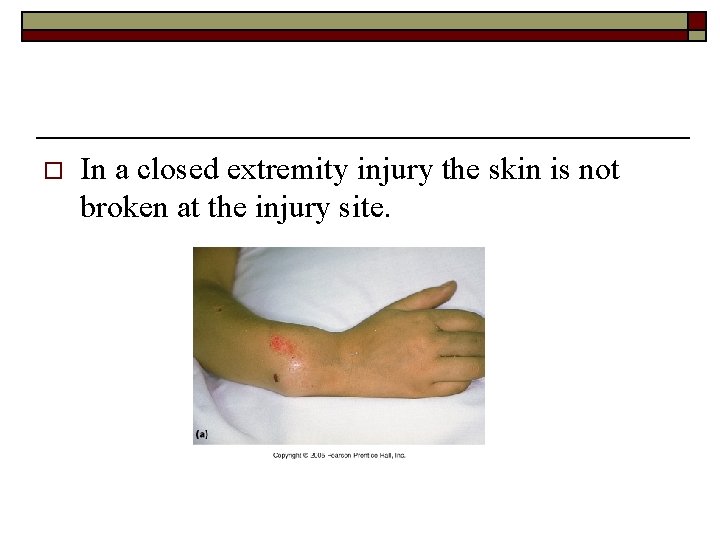 o In a closed extremity injury the skin is not broken at the injury