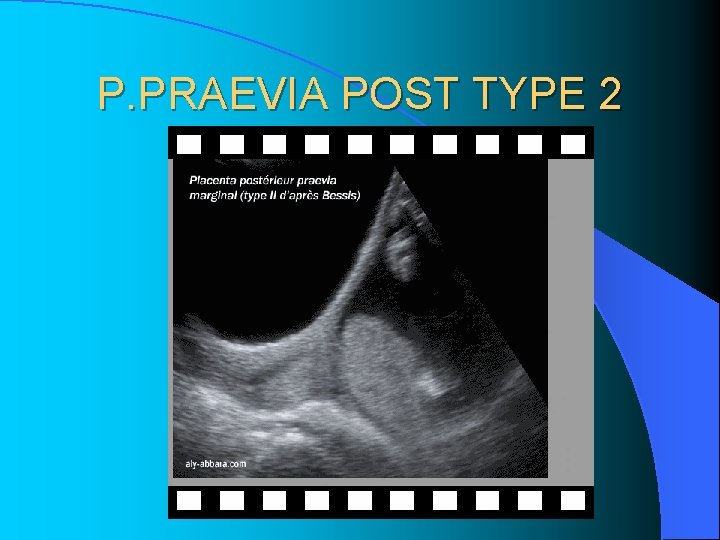 P. PRAEVIA POST TYPE 2 P. PRAEVIA POST TYPE 2