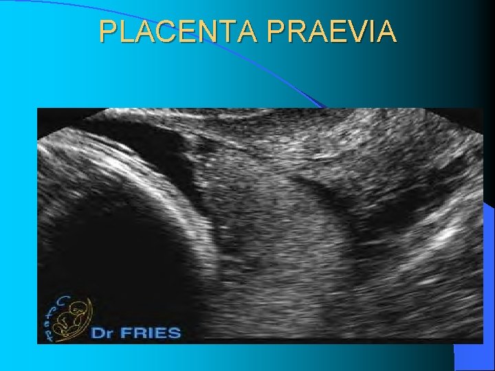 PLACENTA PRAEVIA PLACENTA PRAEVIA