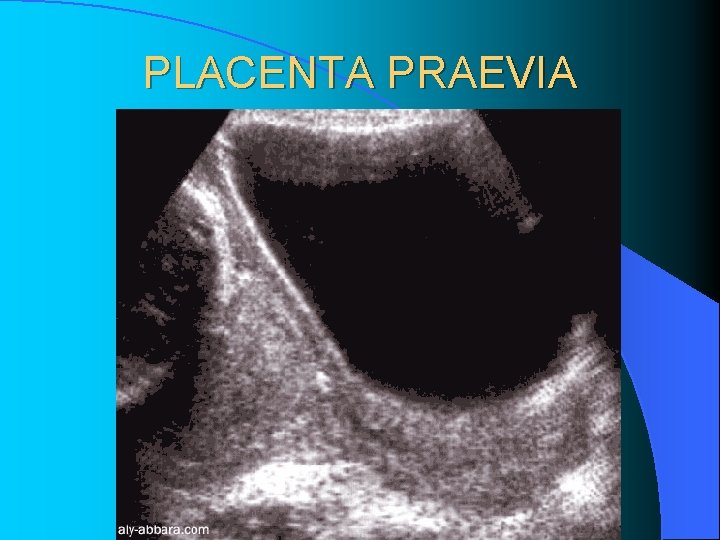 PLACENTA PRAEVIA PLACENTA PRAEVIA