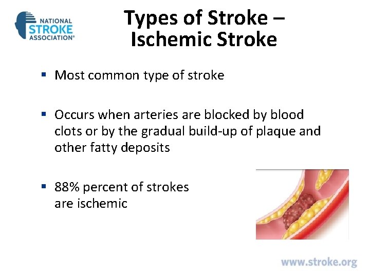 Types of Stroke – Ischemic Stroke § Most common type of stroke § Occurs Types of Stroke – Ischemic Stroke § Most common type of stroke § Occurs