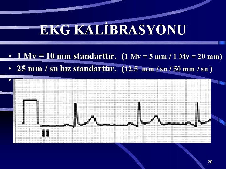 EKG KALİBRASYONU • 1 Mv = 10 mm standarttır. (1 Mv = 5 mm