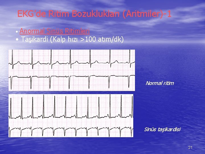EKG’de Ritim Bozuklukları (Aritmiler)-1 Anormal Sinüs Ritimleri • Taşikardi (Kalp hızı >100 atım/dk) •