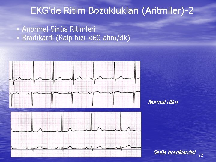 EKG’de Ritim Bozuklukları (Aritmiler)-2 • Anormal Sinüs Ritimleri • Bradikardi (Kalp hızı <60 atım/dk)