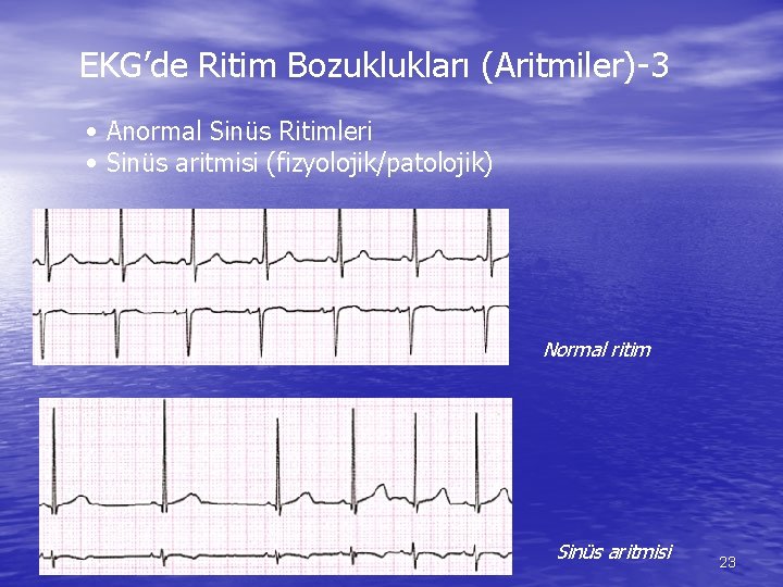 EKG’de Ritim Bozuklukları (Aritmiler)-3 • Anormal Sinüs Ritimleri • Sinüs aritmisi (fizyolojik/patolojik) Normal ritim