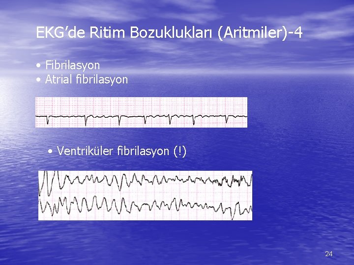 EKG’de Ritim Bozuklukları (Aritmiler)-4 • Fibrilasyon • Atrial fibrilasyon • Ventriküler fibrilasyon (!) 24
