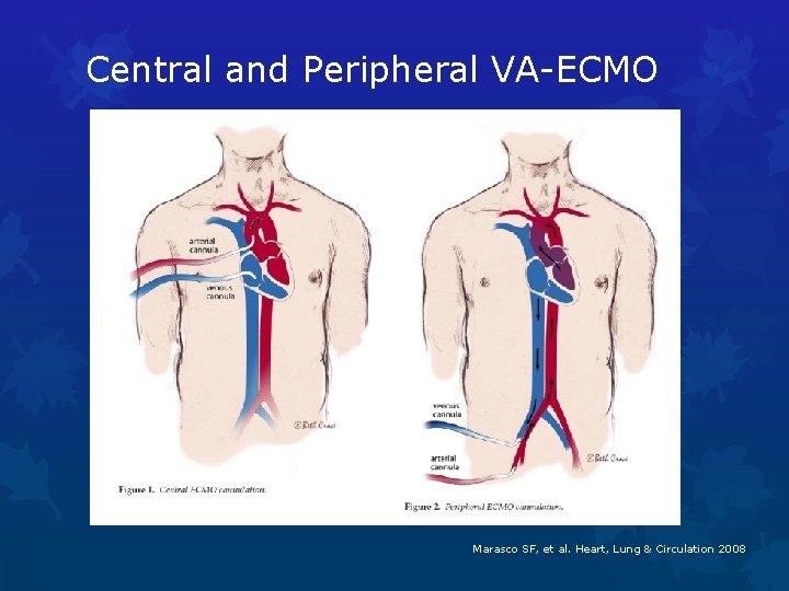 Central and Peripheral VA-ECMO Marasco SF, et al. Heart, Lung & Circulation 2008 