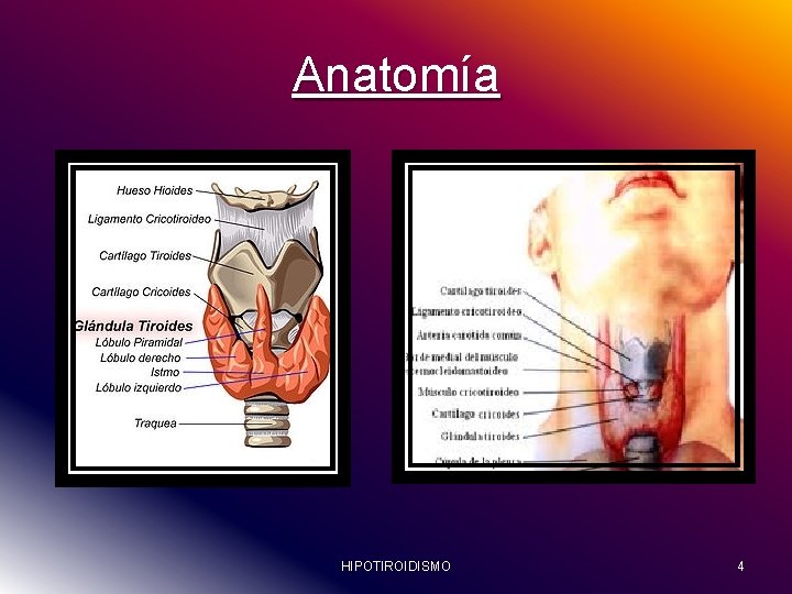 Anatomía HIPOTIROIDISMO 4 