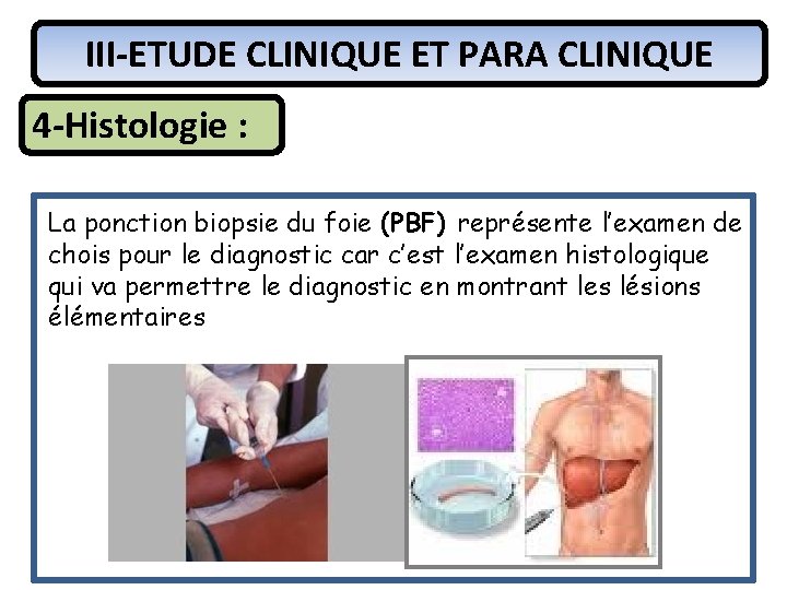 III-ETUDE CLINIQUE ET PARA CLINIQUE 4 -Histologie : La ponction biopsie du foie (PBF)