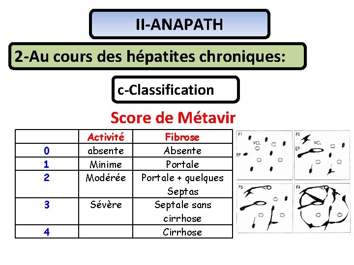 II-ANAPATH 2 -Au cours des hépatites chroniques: c-Classification Score de Métavir 0 1 2