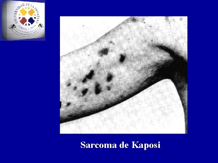 Sarcoma de Kaposi 