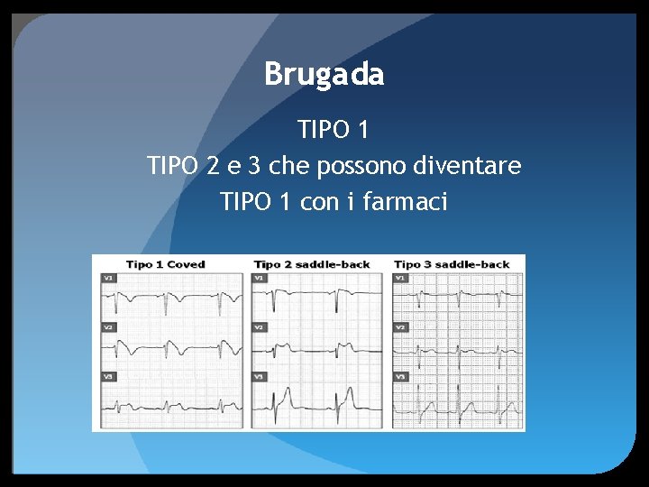 Brugada TIPO 1 TIPO 2 e 3 che possono diventare TIPO 1 con i