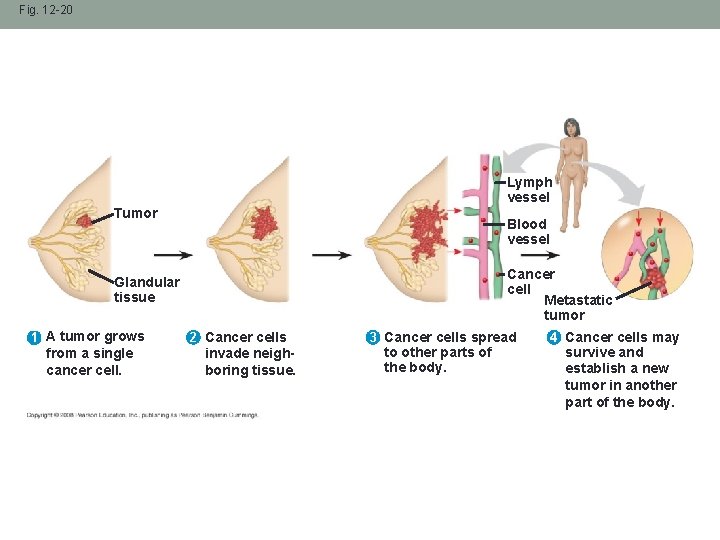 Fig. 12 -20 Lymph vessel Tumor Blood vessel Cancer cell Metastatic tumor Glandular tissue