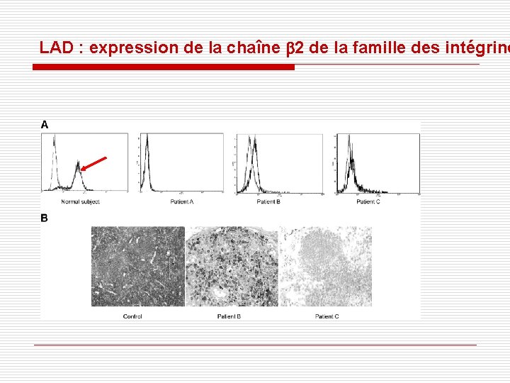 LAD : expression de la chaîne b 2 de la famille des intégrine LAD : expression de la chaîne b 2 de la famille des intégrine