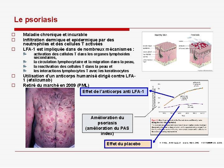 Le psoriasis o o o Maladie chronique et incurable Infiltration dermique et epidermique par Le psoriasis o o o Maladie chronique et incurable Infiltration dermique et epidermique par