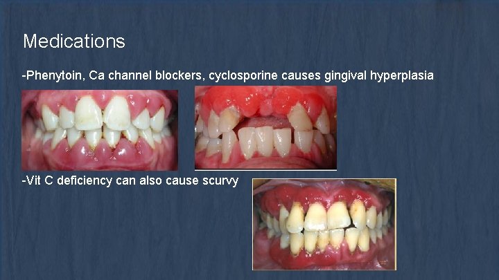 Medications -Phenytoin, Ca channel blockers, cyclosporine causes gingival hyperplasia -Vit C deficiency can also