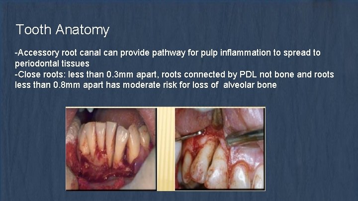 Tooth Anatomy -Accessory root canal can provide pathway for pulp inflammation to spread to