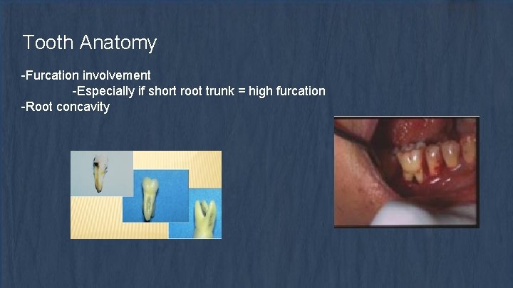Tooth Anatomy -Furcation involvement -Especially if short root trunk = high furcation -Root concavity