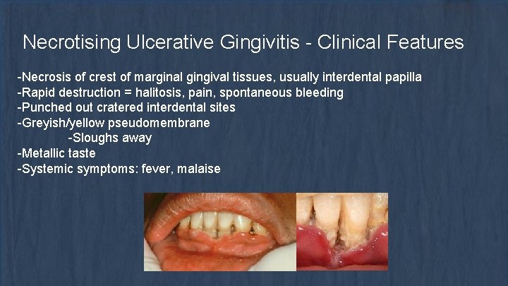 Necrotising Ulcerative Gingivitis - Clinical Features -Necrosis of crest of marginal gingival tissues, usually