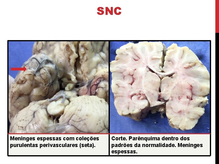 SNC Meninges espessas com coleções purulentas perivasculares (seta). Corte. Parênquima dentro dos padrões da