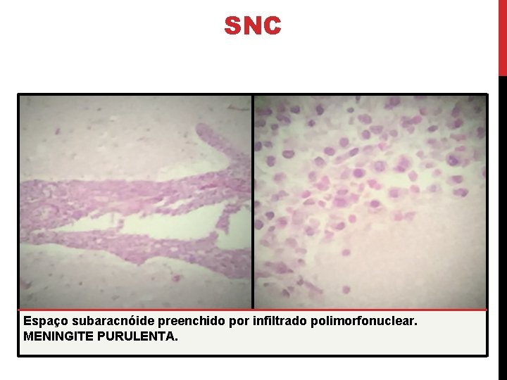 SNC Espaço subaracnóide preenchido por infiltrado polimorfonuclear. MENINGITE PURULENTA. 