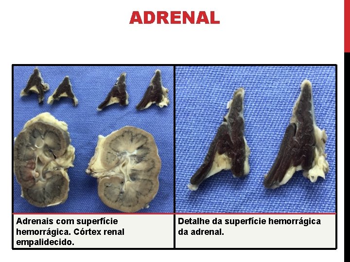 ADRENAL Adrenais com superfície hemorrágica. Córtex renal empalidecido. Detalhe da superfície hemorrágica da adrenal.