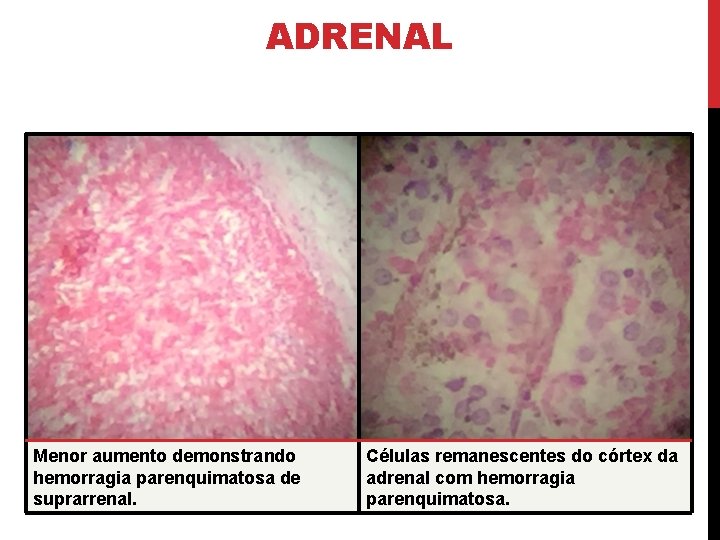 ADRENAL Menor aumento demonstrando hemorragia parenquimatosa de suprarrenal. Células remanescentes do córtex da adrenal