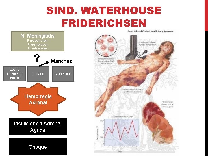 SIND. WATERHOUSE FRIDERICHSEN N. Meningitidis Pseudomonas Pneumococos H. influenzae ? Lesao Endotelial direta Manchas