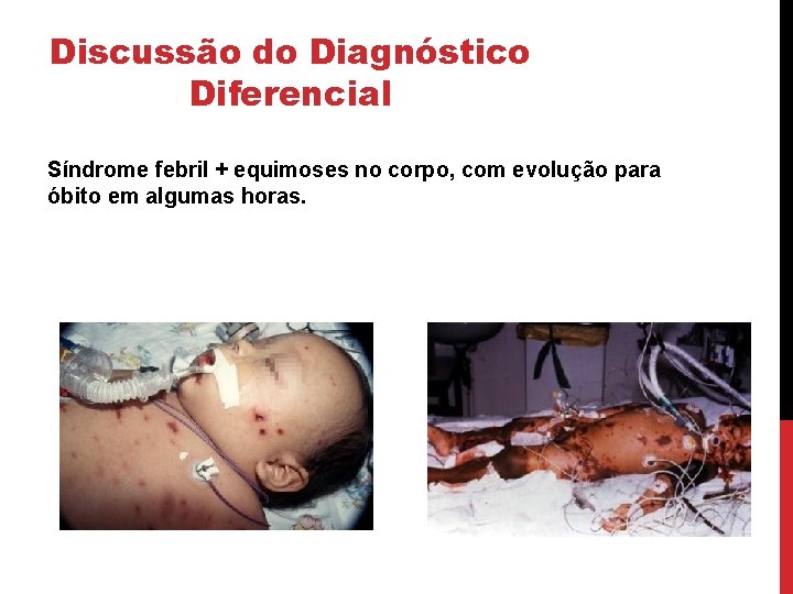 Discussão do Diagnóstico Diferencial Síndrome febril + equimoses no corpo, com evolução para óbito