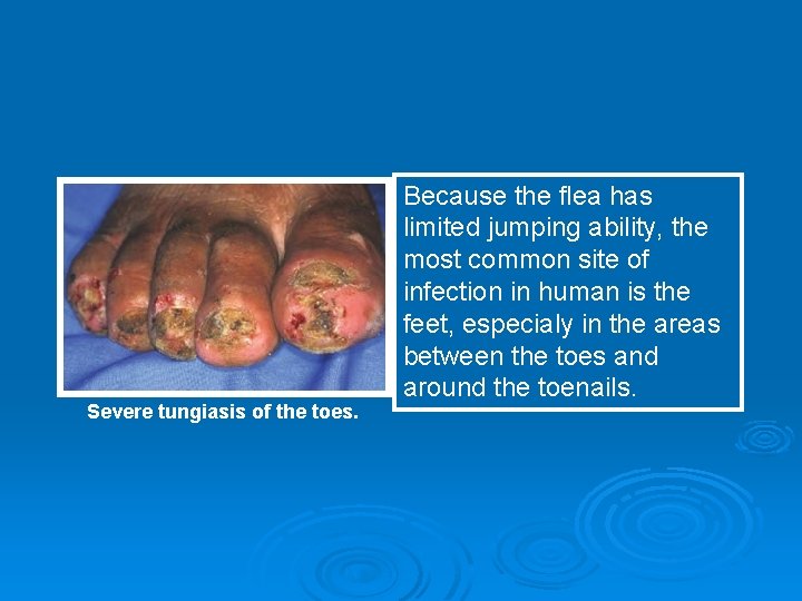 Severe tungiasis of the toes. Because the flea has limited jumping ability, the most